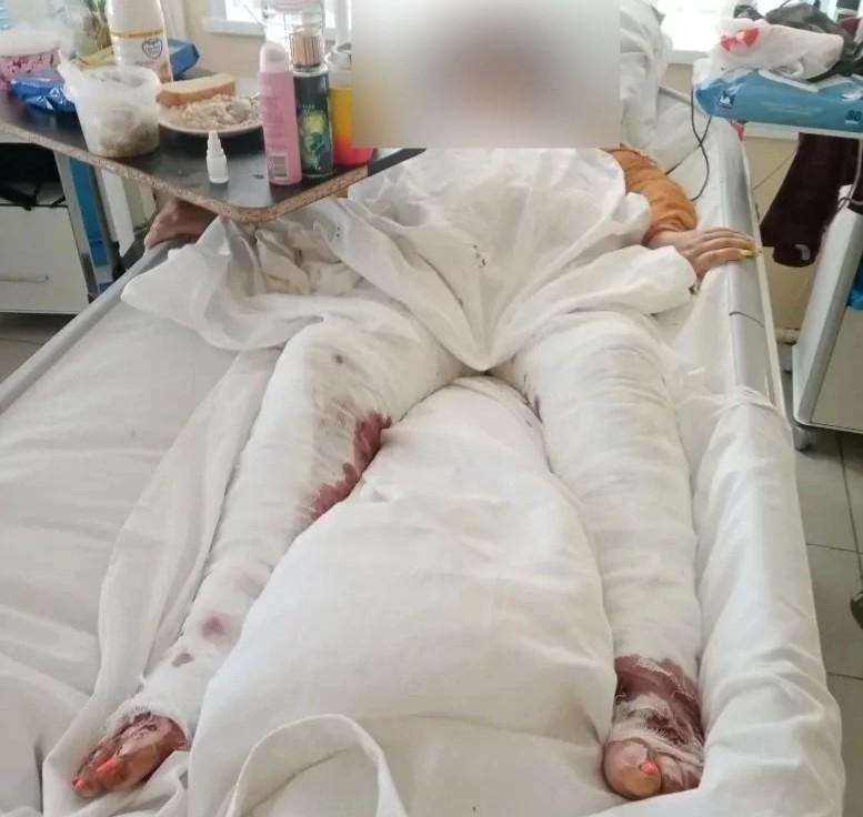 Что стало с астраханкой, упавшей в яму с кипятком